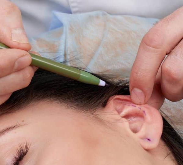 רשלנות רפואית בניתוח הצמדת אוזניים